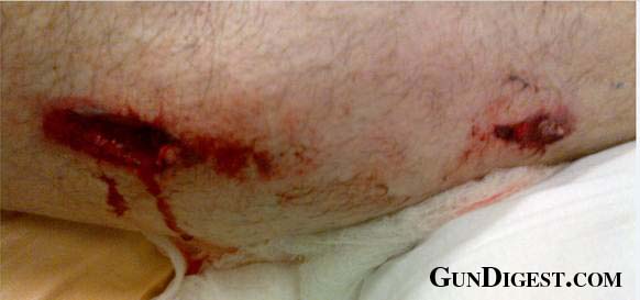 legwound